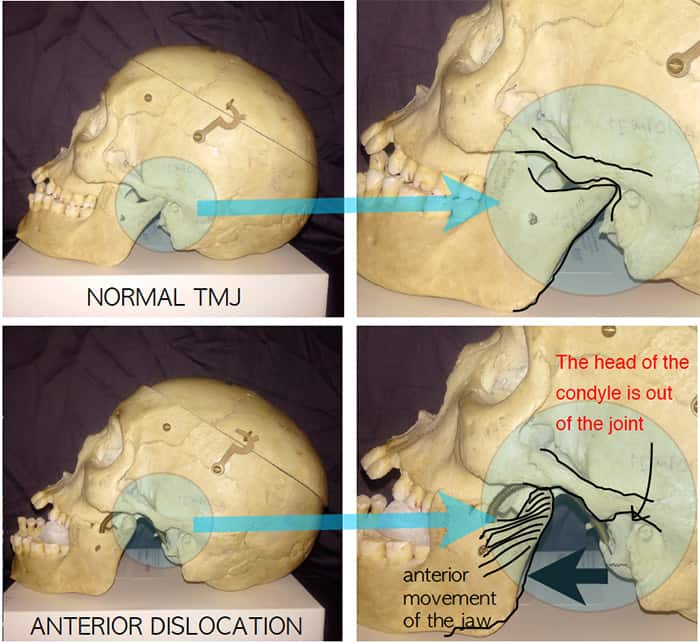 Reducing a Dislocated Jaw A new way to do it. Resus