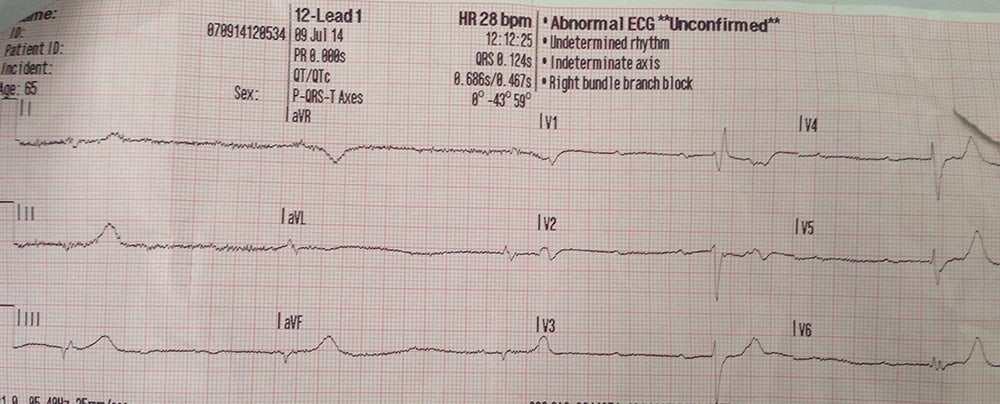 External Pacing | Emergency Medicine Education | Resus