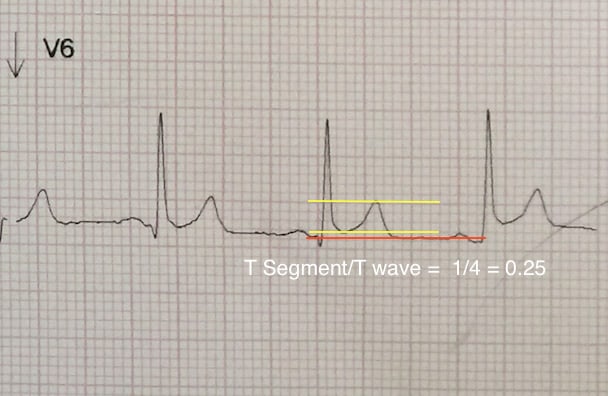 st segment elevation pericarditis