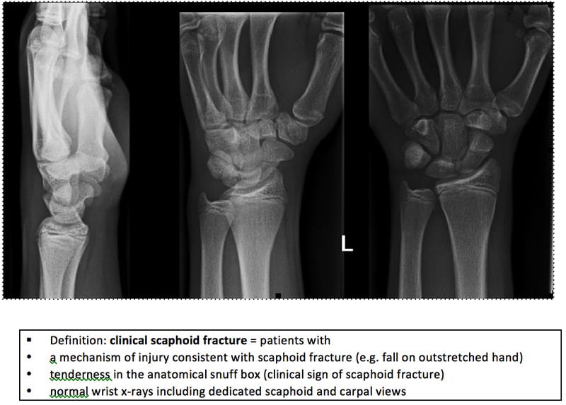 Anatomical snuff box, Radiology Reference Article