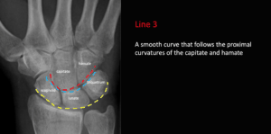 Gilula's carpal arcs