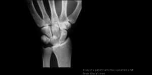 lunate dislocation