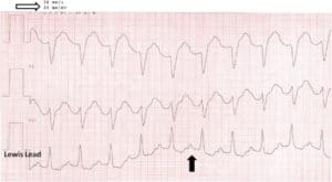 The Lewis Lead - Resus