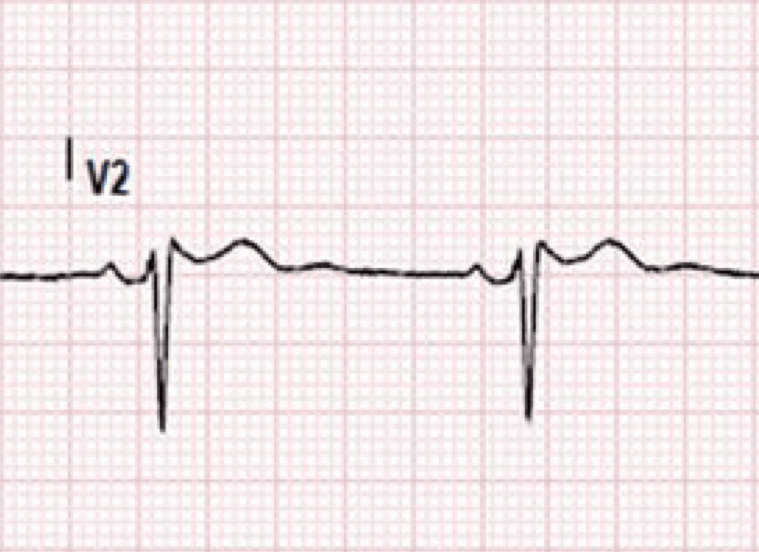 Brugada Syndrome | Emergency Medicine Education | Resus