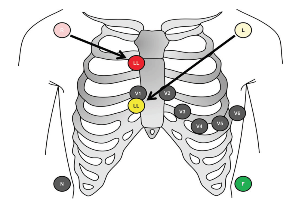 The Lewis Lead | Emergency Medicine Education | Resus