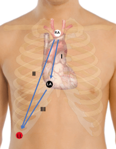 The Lewis Lead - Resus