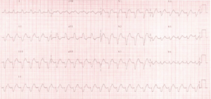 The Lewis Lead - Resus