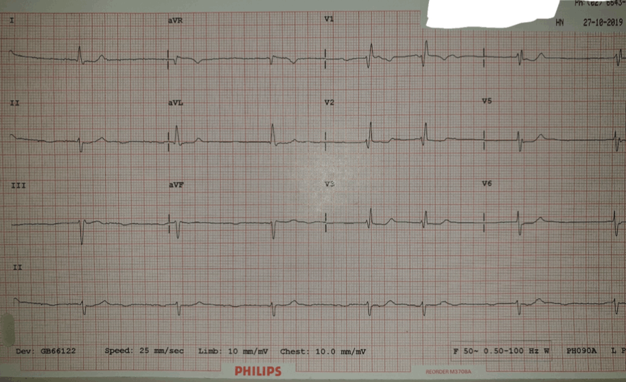 Complete Heart Block Vs Slow Af