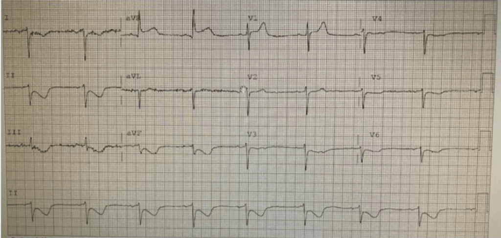 ischaemia