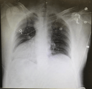 Dextrocardia