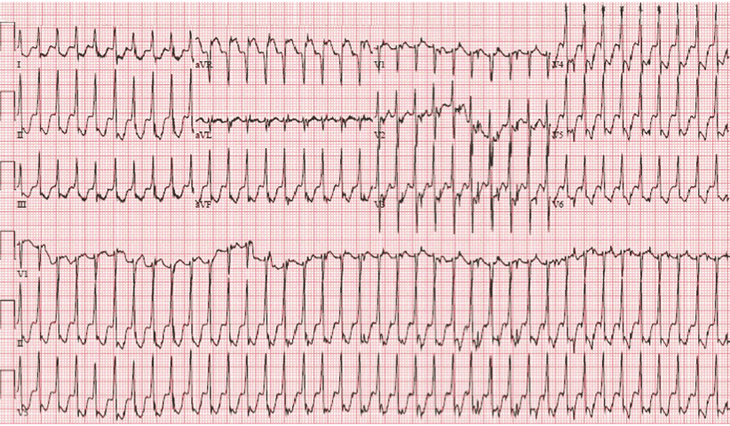 220 bpm with ST elevation in aVR and diffuse ST depression