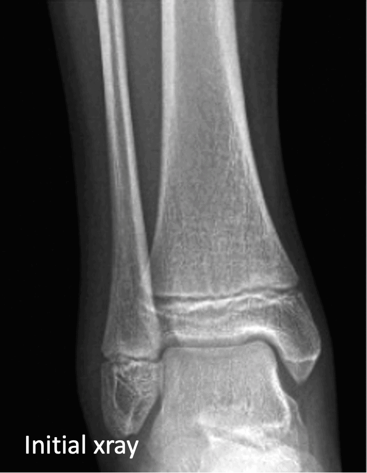 Ankle Injury X-ray - Emergency Medicine Education - Resus