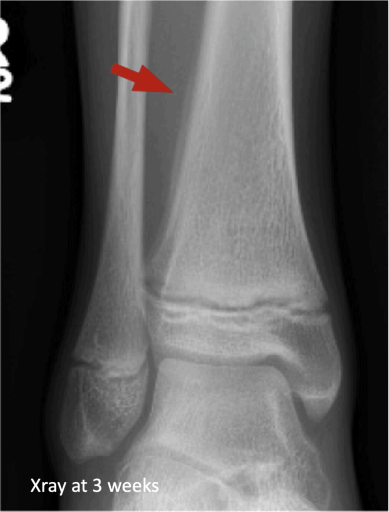 Fracture X-ray - Emergency Medicine Education - Resus