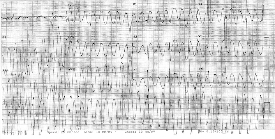 Wide complex tachycardia ECG