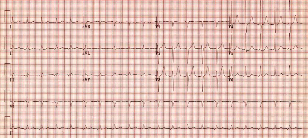 ectopic-atrial-tachycardia-inverted-p-waves_orig-4378086-20230813182719