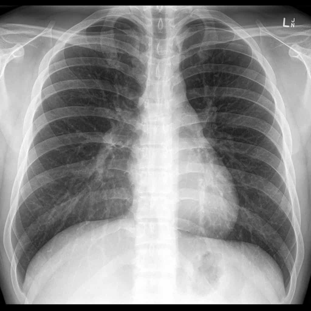 aortic dissection x ray