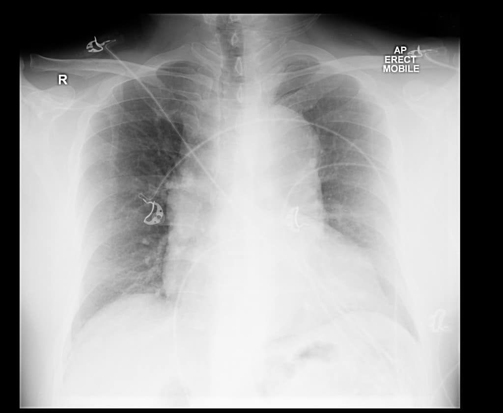 Is it Thoracic Aortic Dissection?