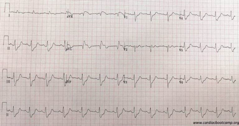 Inotropes and Vasopressors: Which one would you use? | Resus