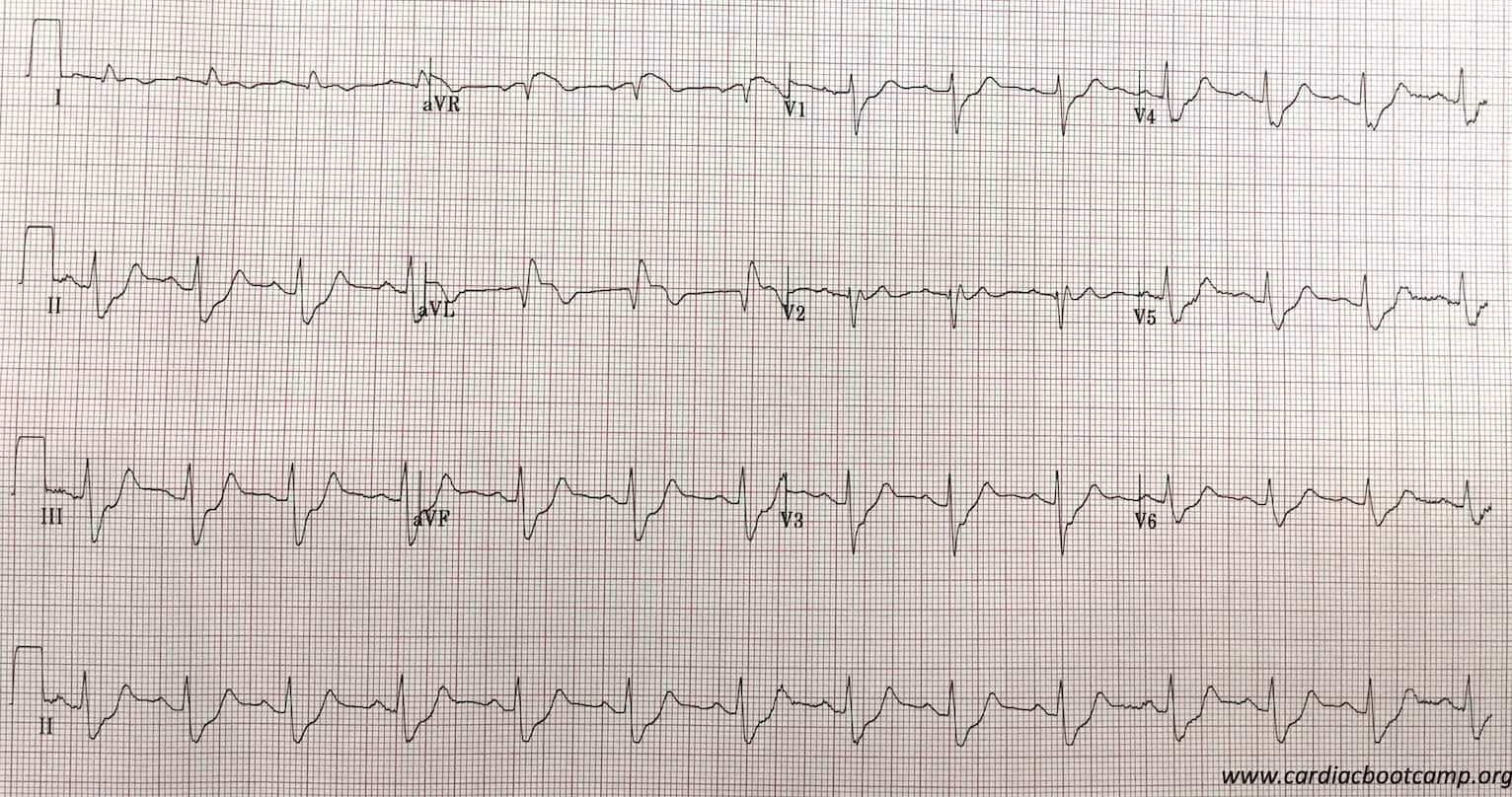 Inotropes and Vasopressors: Which one would you use? | Resus