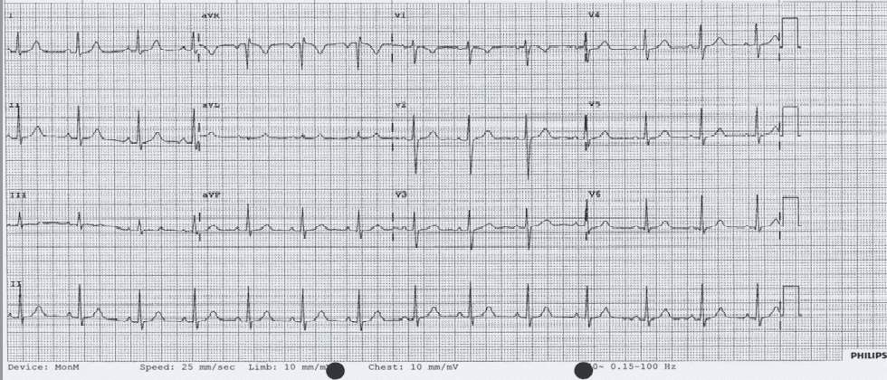 HELLP Syndrome