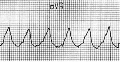 initial-r-wave-in-avr-2730421-20230813184439