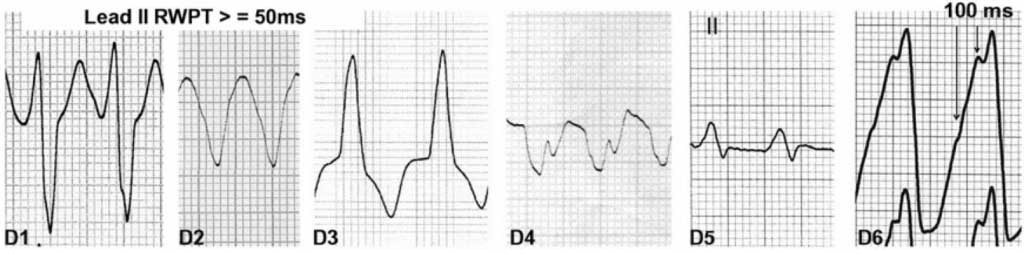 lead-ii-r-wave-peak-time_orig-8655202-20230813184440