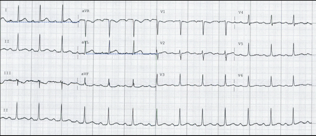 ECG 3