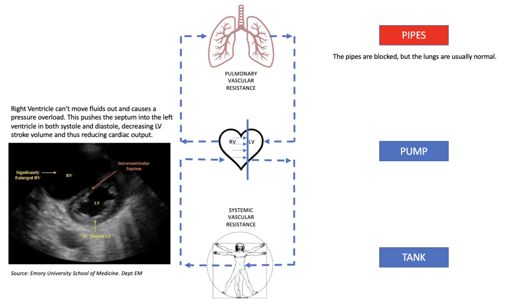 Right Ventricular Spiral of Death