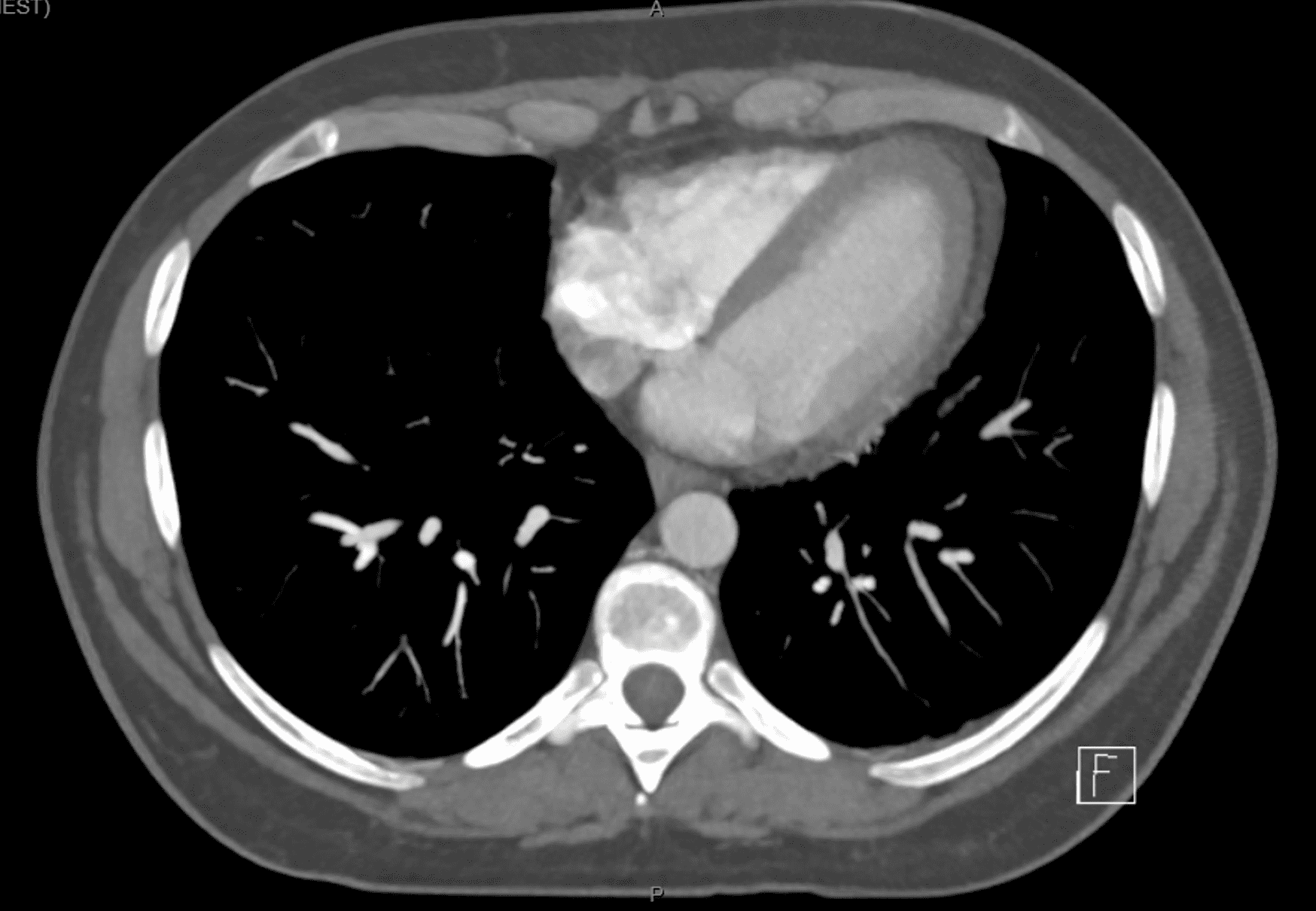 Epicardial Fat Necrosis Resus