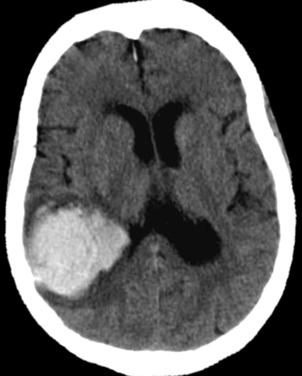 Guidelines for the Management of Spontaneous Intracerebral Haemorrhage.