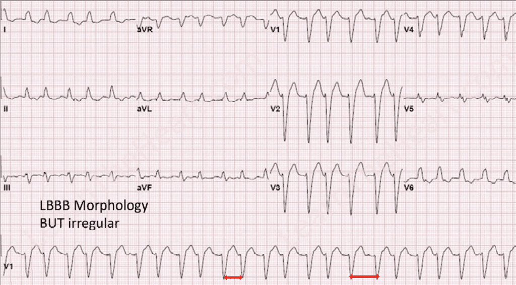 ECG of the Week | Emergency Medicine Education | Resus