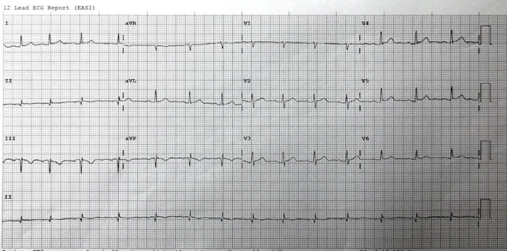 A 19yo with palpitations and atypical chest pain | Resus