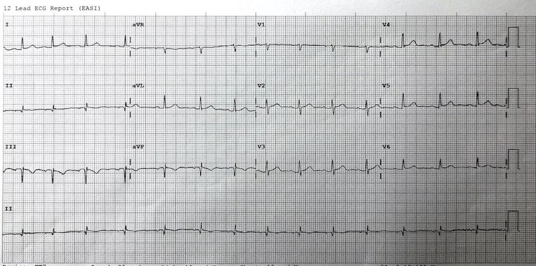 19yo - palpitations - atypical chest pain