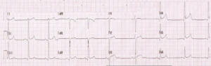 Depolarisation -resus