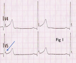 Depolarisation -resus