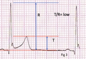 Depolarisation -resus