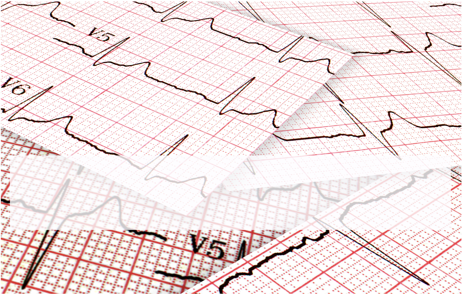 WHAT IF WE COULD PREDICT BY EVOLVING ECG CHANGES WHO WAS GOING TO ARREST?