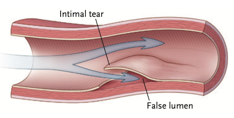 Spontaneous Coronary Artery Dissection(SCAD)