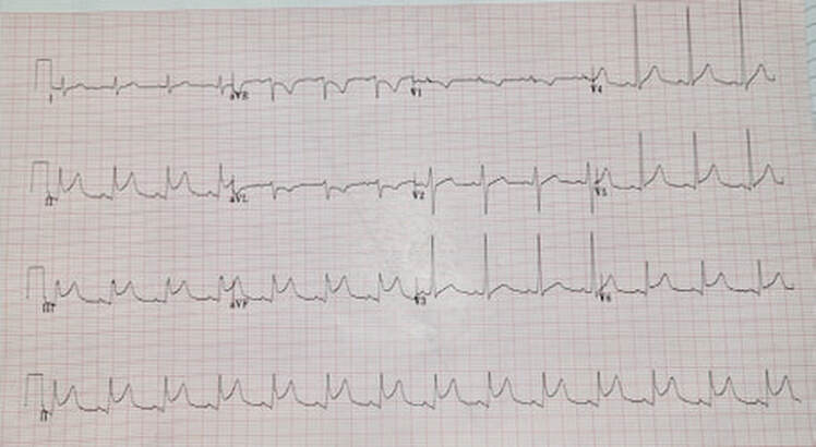A 35 yo with sharp chest pain