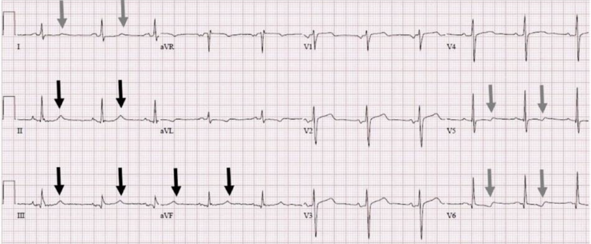 The Non Specific T Wave Abnormality Resus   Screenshot 2023 05 15 At 4 56 29 Pm Orig 