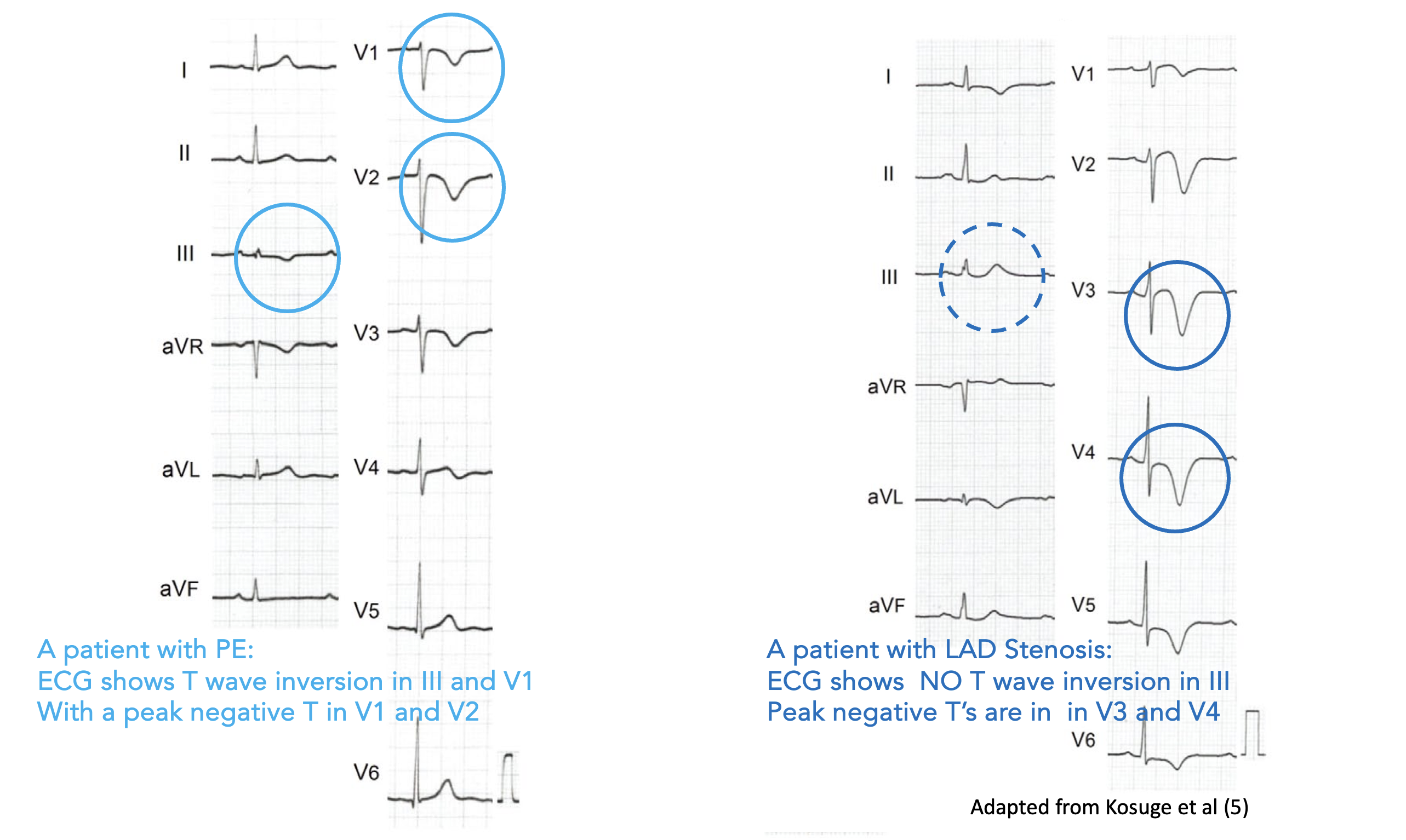 Can the ECG help us differentiate PE from ACS?