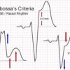 sgarbossa-criteria-lbbb-paced-rhythm