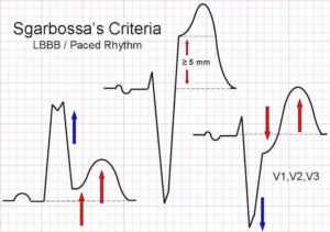 sgarbossa-criteria-lbbb-paced-rhythm
