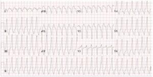 vt-with-lbbb-morphology-and-inferior-axis-minor-criterion-recorded-from-ac-patient