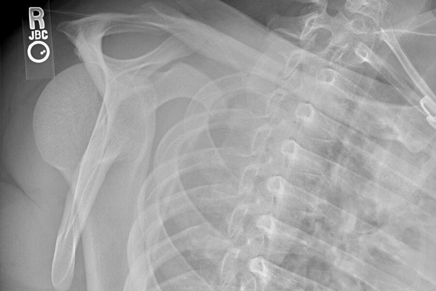 Posterior Shoulder Dislocation
