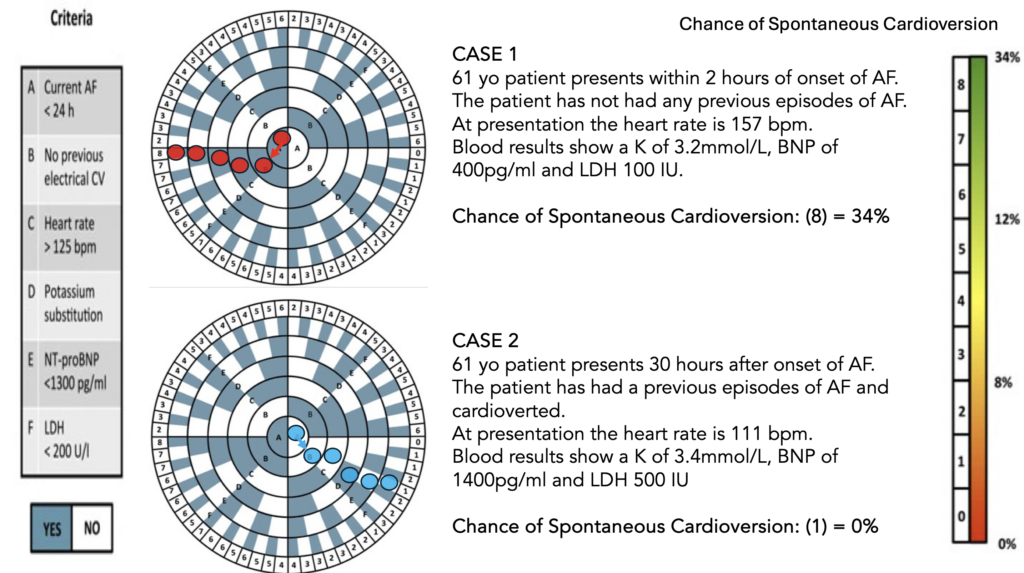 Predicting Spontaneous Reversion of New Atrial Fibrillation | Resus