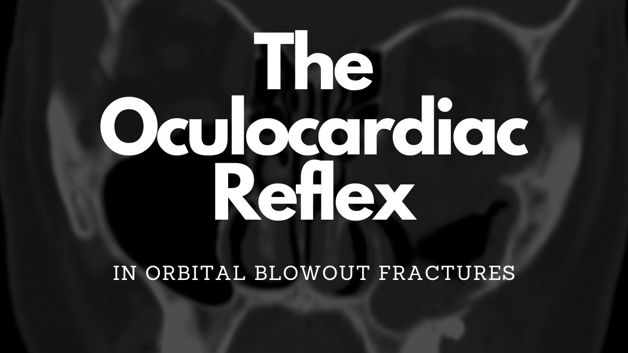 Orbital blowout fracture causing syncope