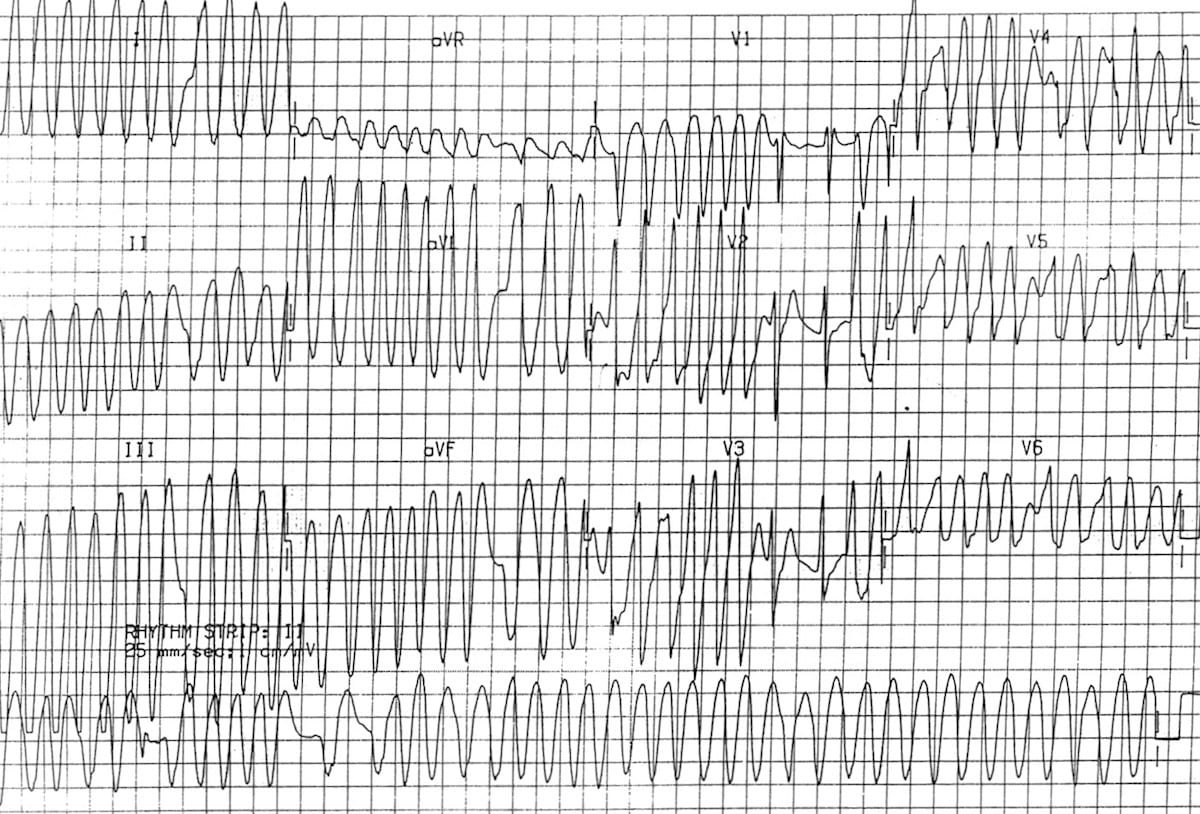 ecg-wpw-atrial-fibrillation-2