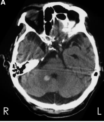 Central Positional Vertigo